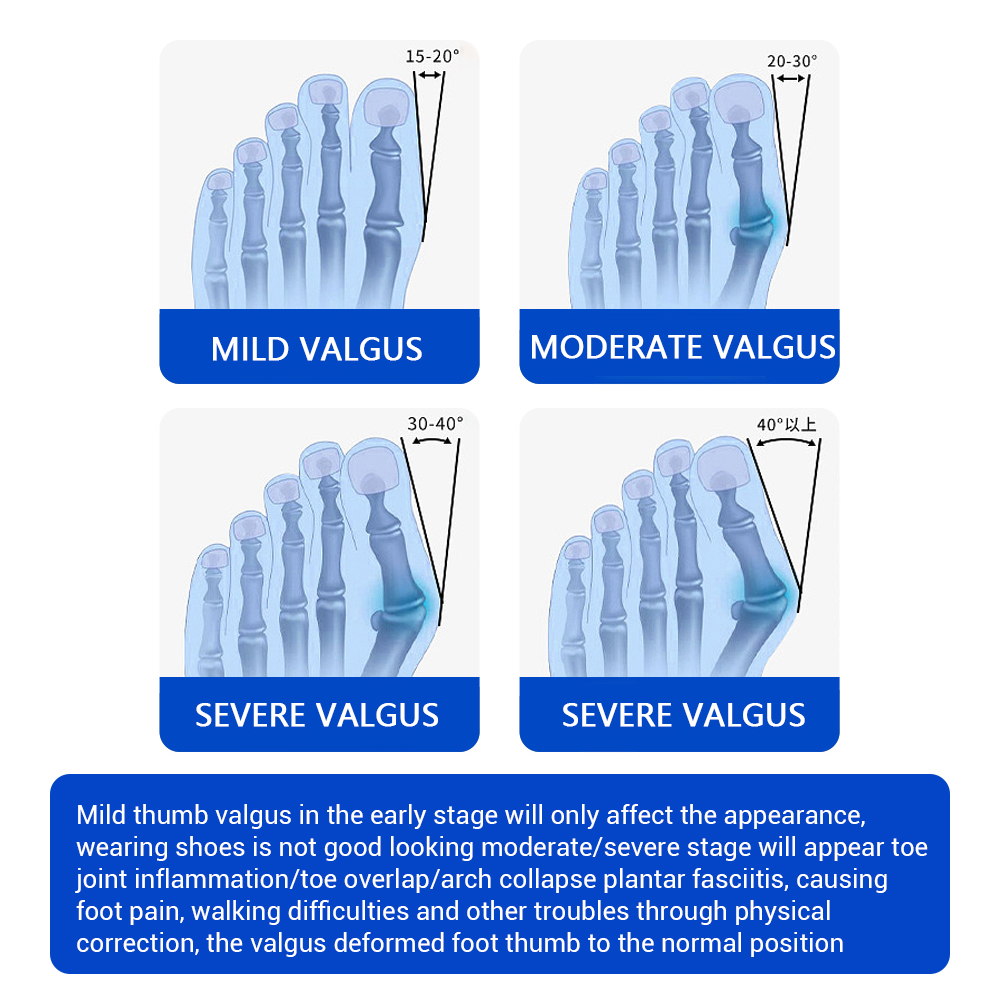 Ajustador de Joanete com Botão - Toe Separator Silicon avaliação e preço